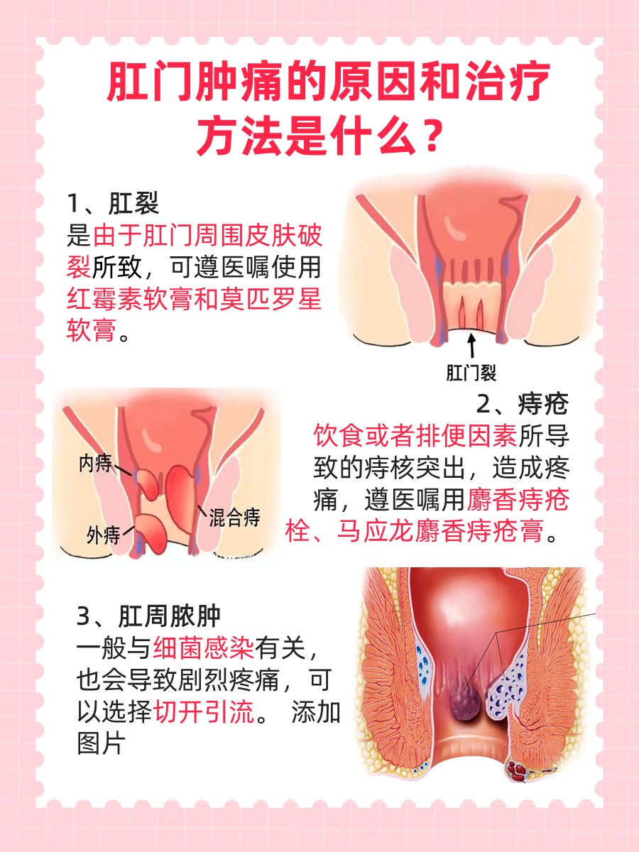 肛门肿痛，原因、治疗方法揭秘