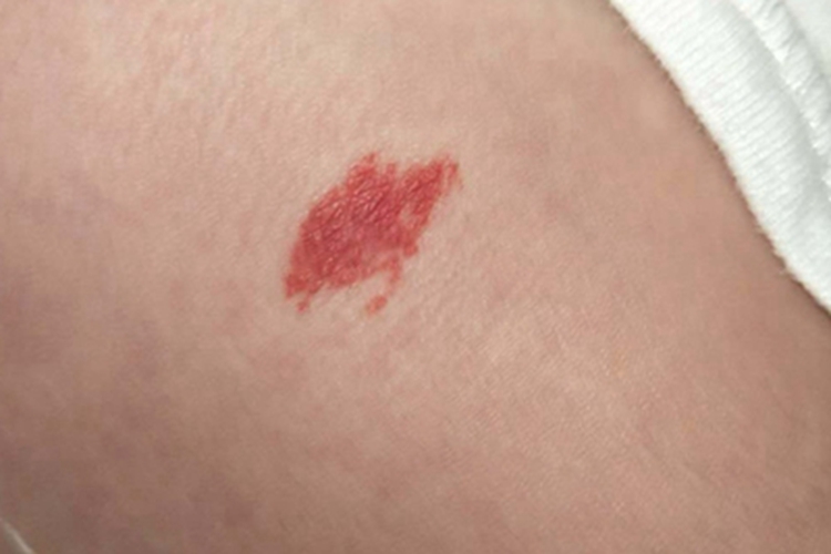 小儿血管瘤腹部有一块红斑图