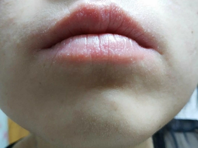 变应性接触性唇炎累及唇缘时,可表现为出现针尖至米粒大小的疱疹,分布
