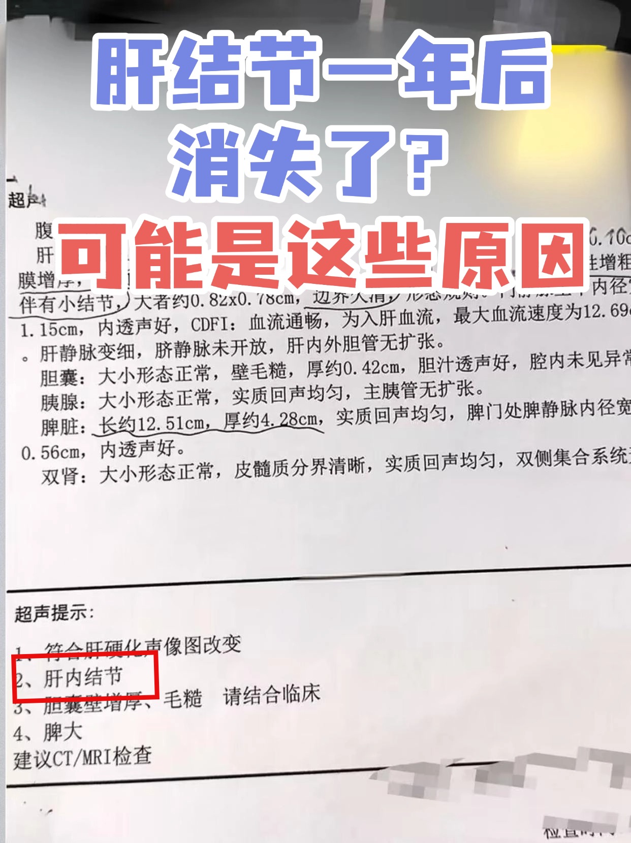 肝结节一年后消失了？可能是这些原因