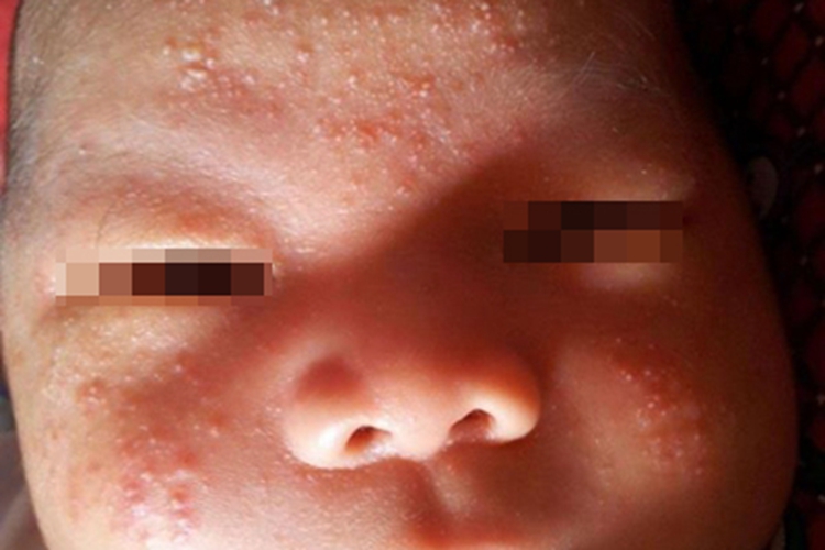 青春期前痤疮脓包图 青春期前痤疮脓包图