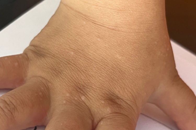 皮脂腺增生手背小疙瘩图
