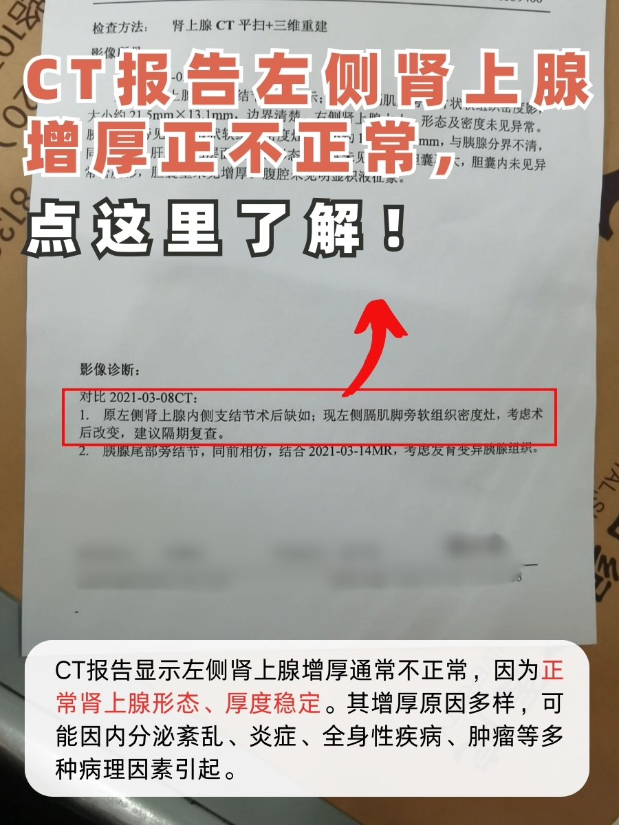 CT报告左侧肾上腺增厚正不正常，点这里了解！