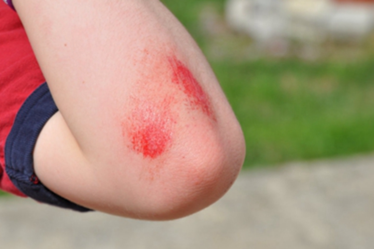 擦伤血点图 擦伤血点图