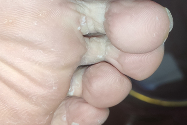 浸渍糜烂型足癣脚趾脱皮图