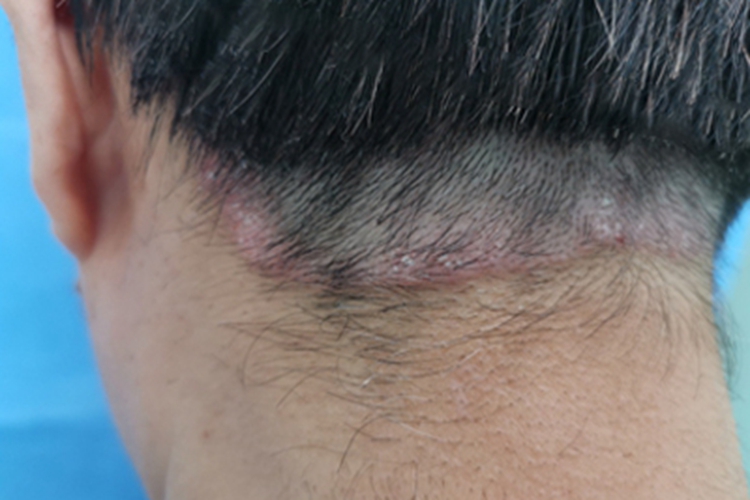 银屑病关节炎头皮红斑图 银屑病关节炎头皮红斑图