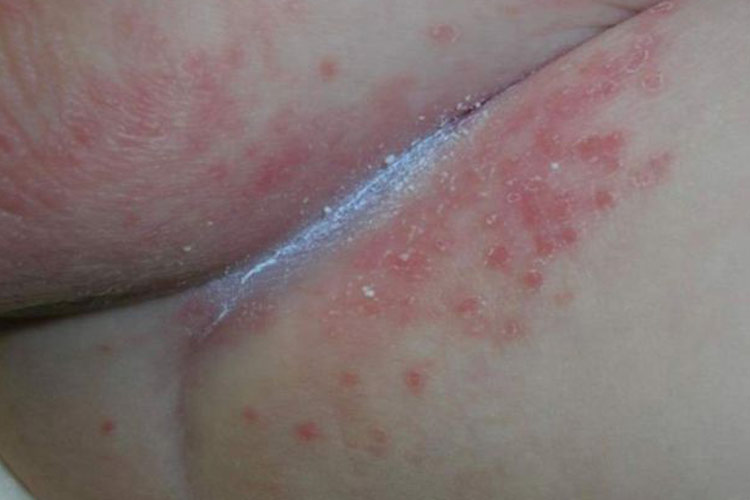 儿童丘疹性肢端皮炎臀部图