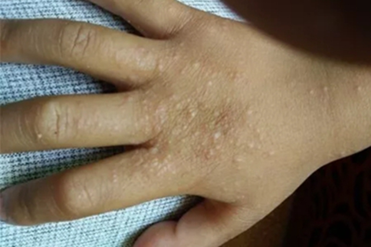 浅表性皮肤脂肪瘤痣手背丘疹图 浅表性皮肤脂肪瘤痣手背丘疹图