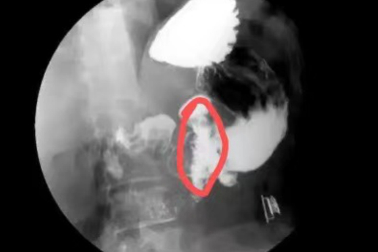 胃肠道肿瘤造影图 胃肠道肿瘤造影图