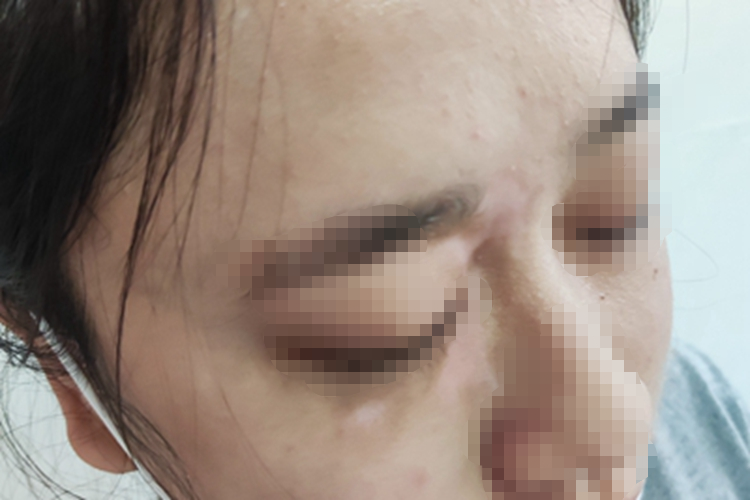 进展期节段型白癜风面部斑图