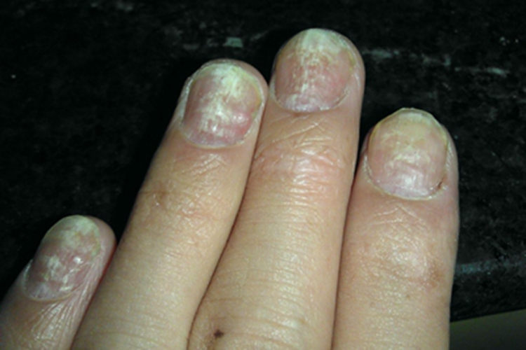 掌跖角皮症手指甲增厚图