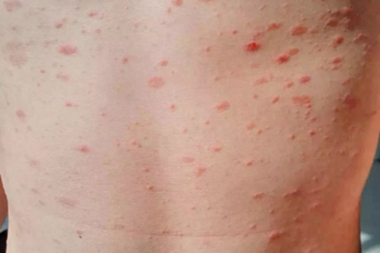 战壕热症状图 战壕热症状图