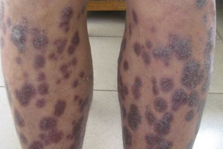 梅毒小腿部位的结节性梅毒疹图
