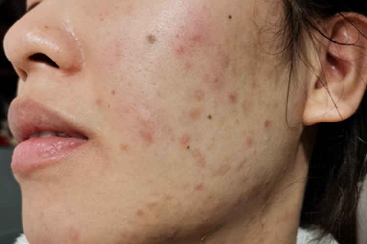 痤疮左脸有许多淡红疙瘩图