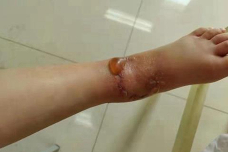 丹毒脚上起大水疱图