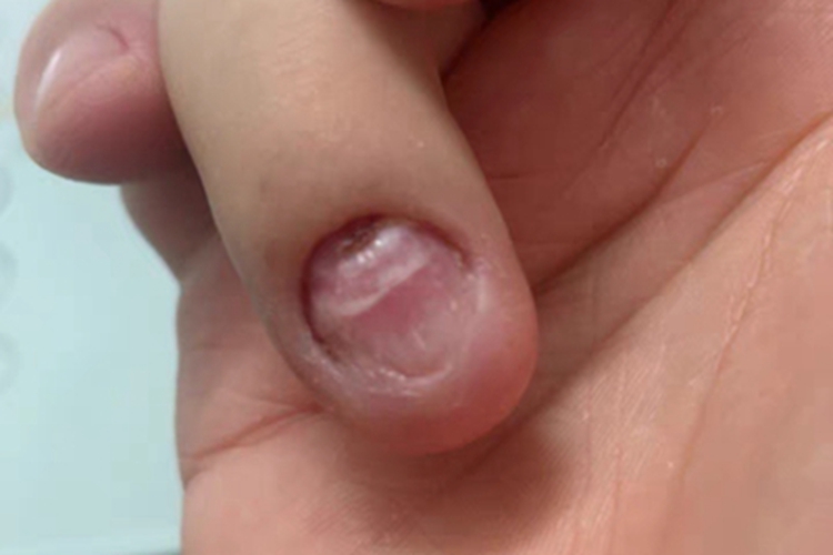 近端甲下型甲真菌病手指甲症状图