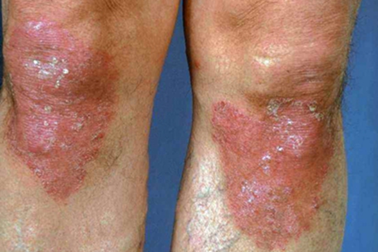 寻常狼疮膝盖症状图