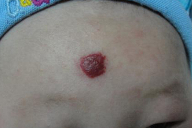 草莓状血管瘤图 草莓状血管瘤图