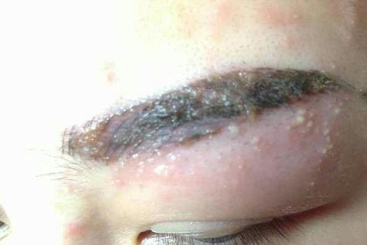 纹眉后发炎感染,表现为纹过的眉毛处有多处毛囊发炎,小脓点,局部红肿