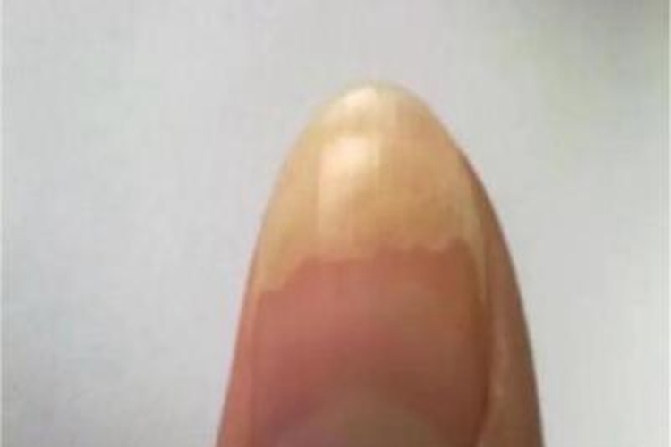 甲分离初期图 甲分离初期图