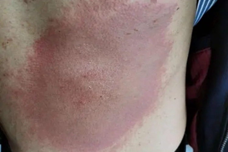 急性接触性皮炎腹部红斑图