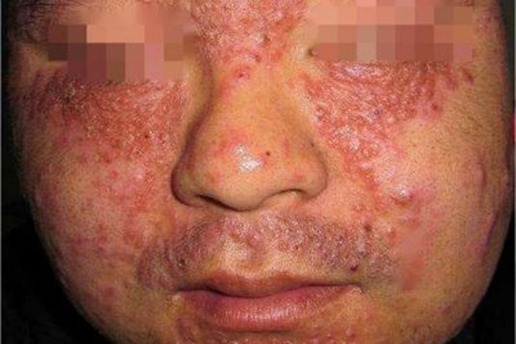 颜面粟粒性狼疮面部症状图 颜面粟粒性狼疮面部症状图