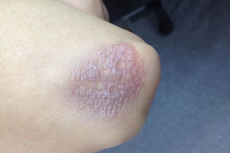 肘部关节局限性神经性皮炎图