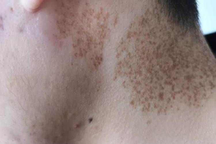 日光性雀斑样痣侧颈长斑图 日光性雀斑样痣侧颈长斑图