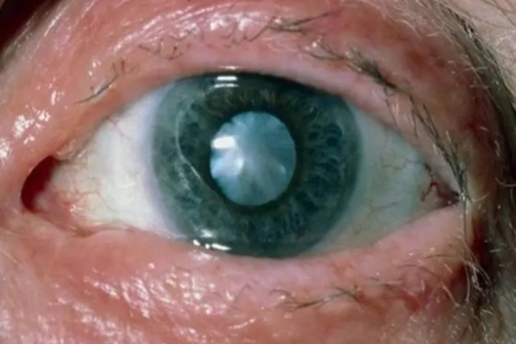 电击伤所致白内障眼睛混浊图