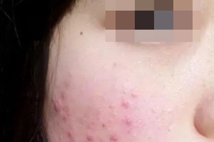 毛囊炎面部长多个小红疙瘩图 毛囊炎面部长多个小红疙瘩图