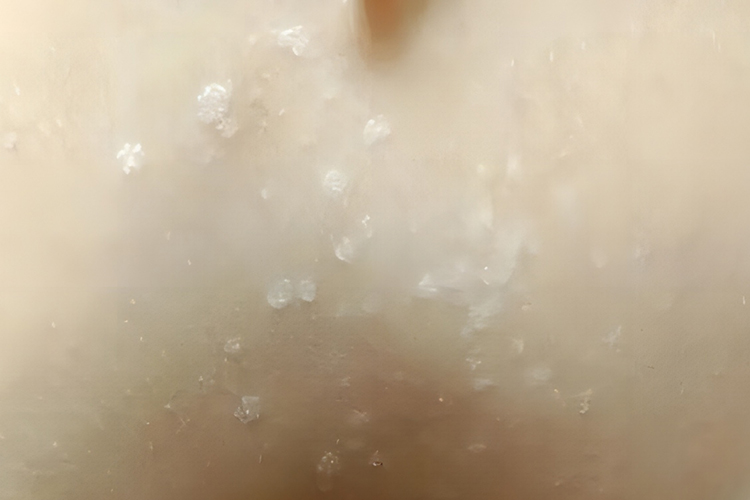 花斑癣早期症状图 花斑癣早期症状图