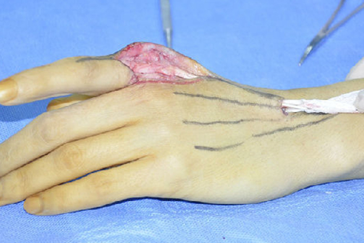 手指肌腱松解术远端牵拉图 手指肌腱松解术远端牵拉图