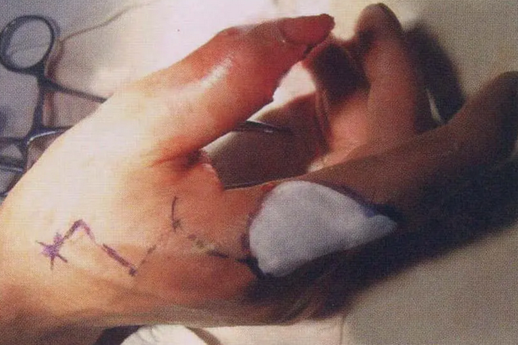 食指背侧岛状皮瓣图 食指背侧岛状皮瓣图