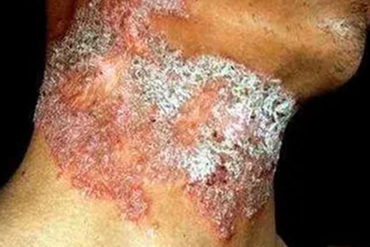 寻常狼疮颈部症状图