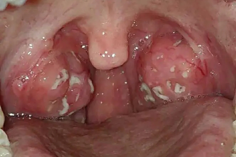 扁桃体颜色异常图