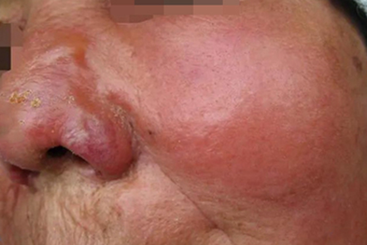 丹毒脸上又红又肿图