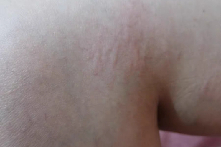 慢性自发性荨麻疹膝盖边有疙瘩图 慢性自发性荨麻疹膝盖边有疙瘩图