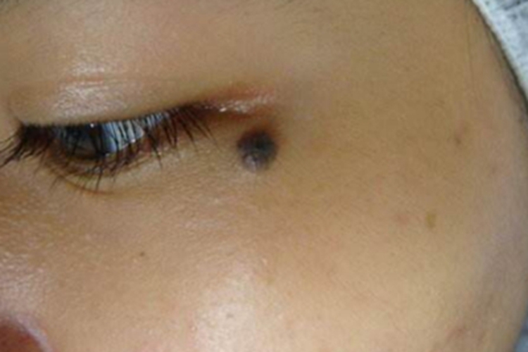 浅表播散型黑色素瘤眼周疙瘩图 浅表播散型黑色素瘤眼周疙瘩图