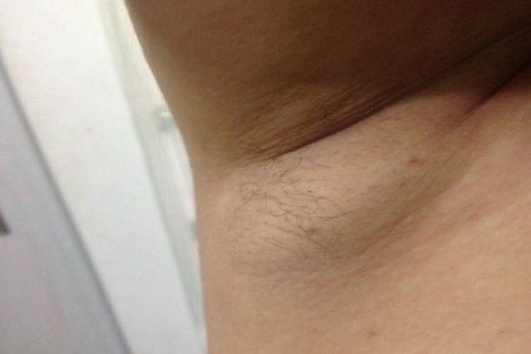 艾滋病腋下淋巴结肿大图