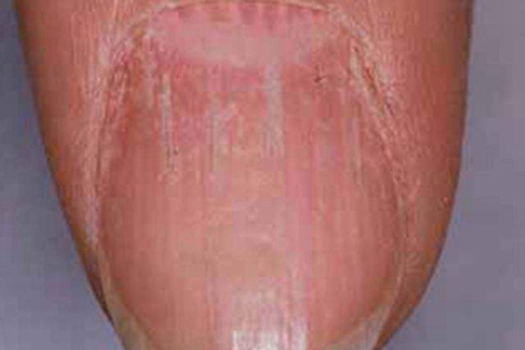 扁平苔藓手指甲很多裂纹图