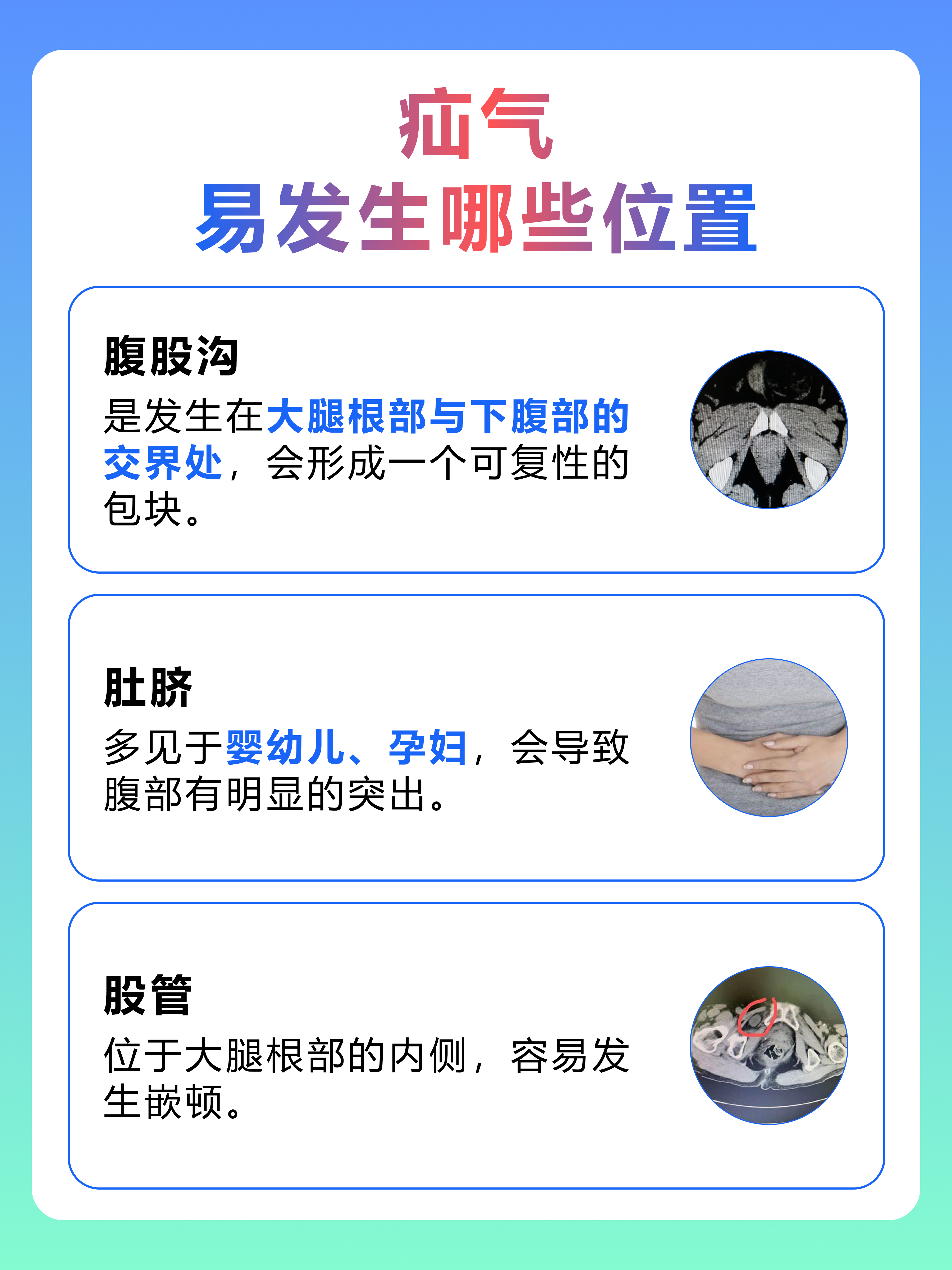 揭秘！疝气悄悄藏身的那些神秘位置？