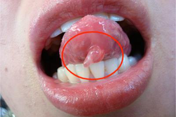 黏液腺囊肿舌头肉球图