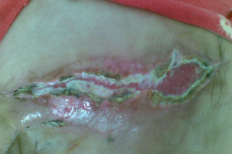 乳腺癌伤口感染不愈合图 乳腺癌伤口感染不愈合图