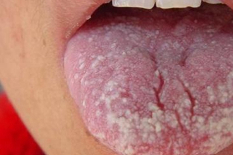 口腔毛状黏膜白斑舌头白斑图