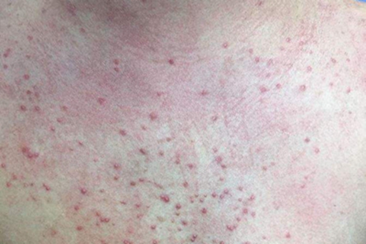 湿疹样紫癜胸部症状图 湿疹样紫癜胸部症状图