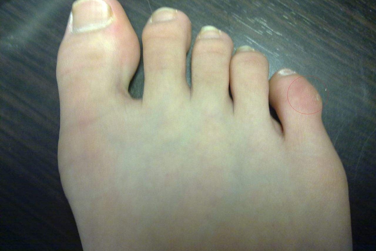 小脚趾骨质增生局部突出图