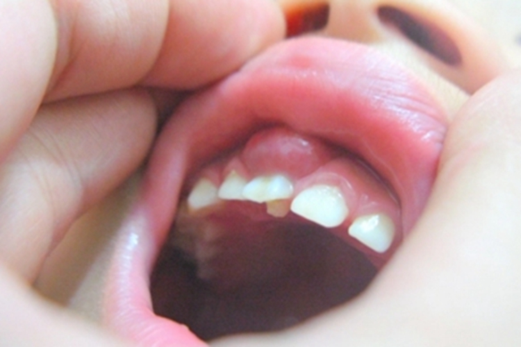 牙槽脓肿牙龈症状图