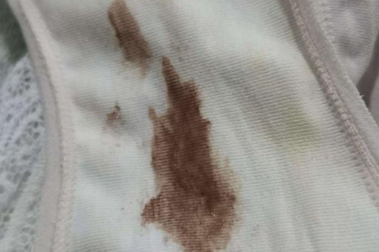 先兆流产褐色分泌物图