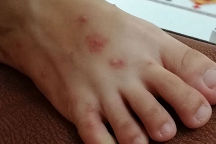 跳蚤叮咬脚背红斑图 跳蚤叮咬脚背红斑图