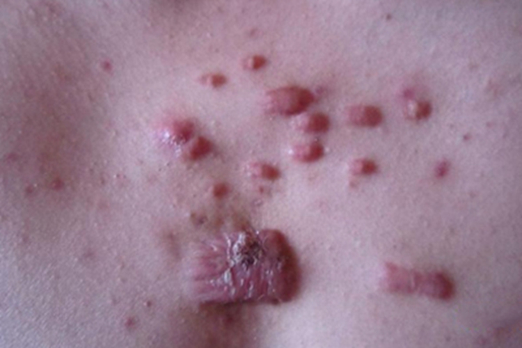 瘢痕疙瘩性芽生菌病胸部症状图